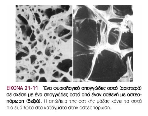 ευνοεί την οστεόλυση (κορτιζόλη) Μείωση ορµόνης που ευνοεί τον