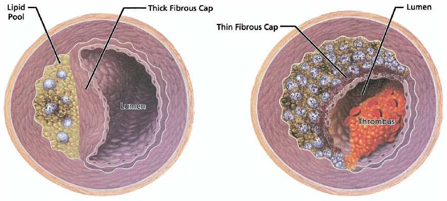 Contrasting histopathologic characteristics of a stable versus ruptured plaque Stable plaque Low