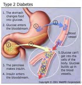 1.2 Τύποι σακχαρώδους διαβήτη Σακχαρώδης Διαβήτης τύπου 1 Ο διαβήτης τύπου 1 ή ινσουλινοεξαρτώμενος προκαλείται από την αυτοάνοση καταστροφή των β-κυττάρων του παγκρέατος που παράγουν ινσουλίνη και