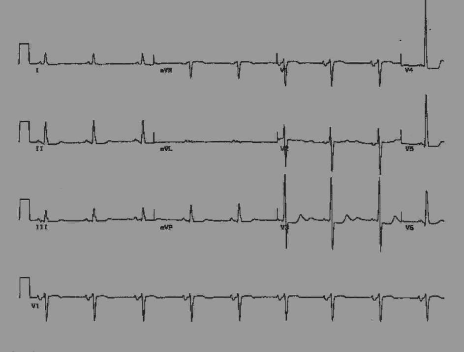 Η.Κ.Γ Υπάρχουν πολλοί δείκτες της υπερτροφίας της αριστεράς κοιλίας Sokolow (Am Heart J 1949): Το άθροισμα των S στη V1 και των R στη V5 (V6) >35 mm Κριτήρια Framingham (Circulation 1990): 1.