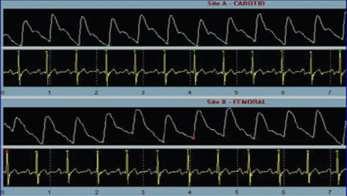 Central Pressures (Systolic Diastolic Pulse