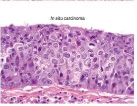 Προδιθκθτικζσ πλακϊδεισ αλλοιϊςεισ Καρκίνωμα in situ (CIS) Πάχοσ μπορεί να μθν είναι αυξθμζνο Απουςία ωρίμανςθσ ςτθν επιφάνεια Ζντονθ κυτταρικι