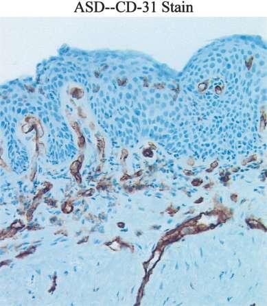 Προδιθκθτικζσ πλακϊδεισ αλλοιϊςεισ Αγγειογόνοσ δυςπλαςία angiogenic squamous dysplasia (ASD) εμφανζςτερθ ςε ΑFB