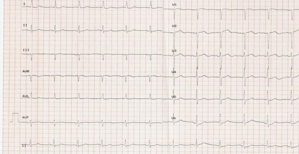 Pacemaker Implantation