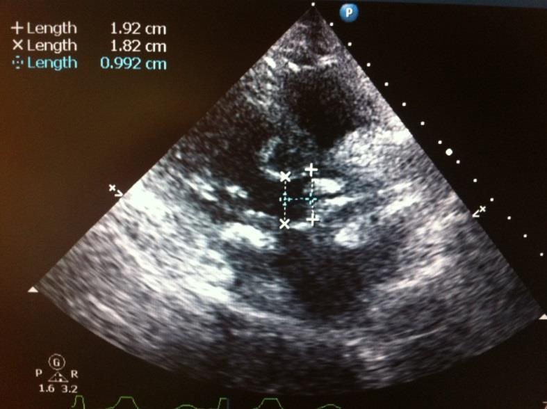 Pacemaker Implantation