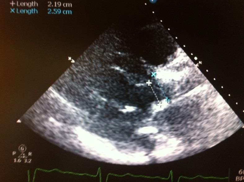 89) LVOT/ANNULUS <0.