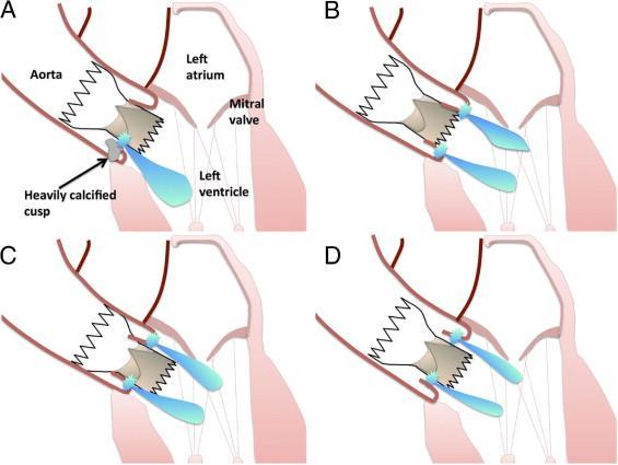 Paravalvular Leak Calcifications of the cusps of the native valve Too shallow valve