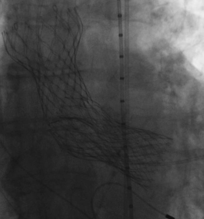 Procedure (Valve-in-Valve) Final result