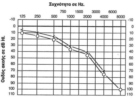 Συμπτώματα της νευροαισθητήριας βαρηκοΐας είναι: Παραμόρφωσή ή χωρίς ευκρίνεια των ήχων αντίληψης της ομιλίας.