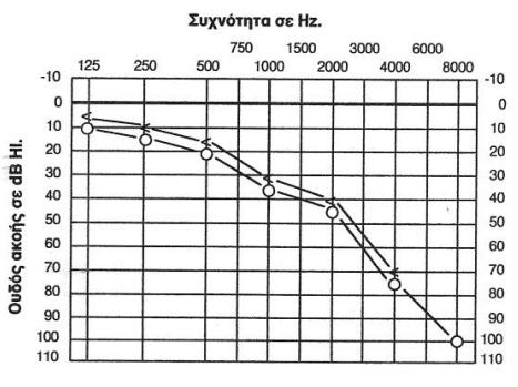 Μεσοκοχλιακός τύπος: Παρατηρείται σε βλάβες που εντοπίζονται στη μεσότητα του