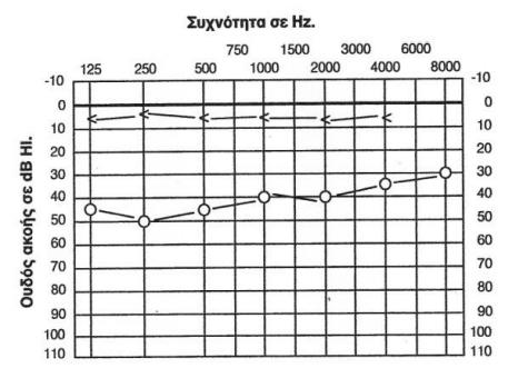 2.3.3 Μικτού τύπου Οι βαρηκοΐες αγωγιμότητας και οι νευροαισθητήριες βαρηκοΐες δεν αλληλοαποκλείονται. Συχνά, οι ασθενείς εμφανίζουν συμπτώματα και από τους δύο τύπους βαρηκοϊών.