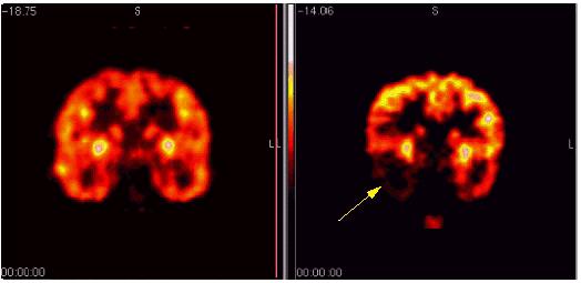 Φυσιολογικός εγκέφαλος Εικόνα του εγκεφάλου ενός κοριτσιού ηλικίας 9 ετών με ιστορικό επιληπτικών κρίσεων που δεν ελέγχονται επαρκώς από φάρμακα.