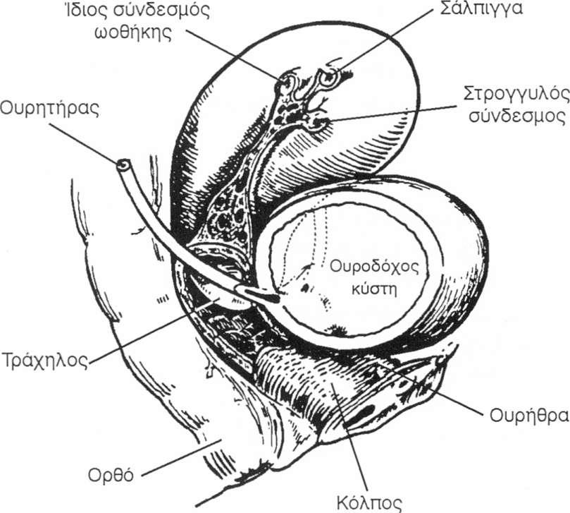 38 αντίστοιχη ενδοουρηθρική και επακολουθεί διαφυγή ούρων.