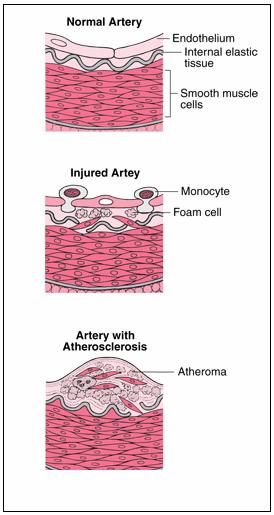 ΕΙΣΑΓΩΓΗ Εικόνα 3. Σχηματικά η σταδιακή ανάπτυξη αθηρωματικής βλάβης σε σημείο φλεγμονής στο τοίχωμα του αγγείου. Image 3. The development of atherosclerosis in an inflammation site of a vessels.