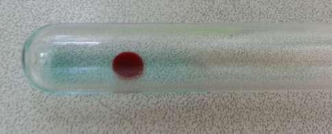 Εικόνα 41: Συγκόλληση των ερυθροκυττάρων με χρήση του αντιορού αντι-α, θετικό αποτέλεσμα. Ύπαρξη αντιγόνου Α στην επιφάνεια των ερυθρών του ασθενούς. Ασθενής ομάδας αίματος Α.
