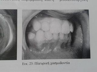 χασμοδοντία.