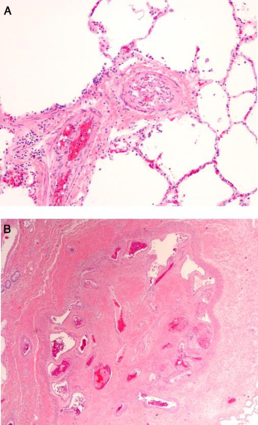 Sickle cell-related pulmonary arterial hypertension Survival curves according to