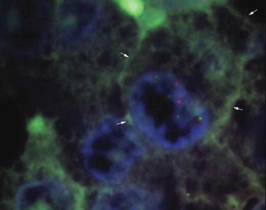 Το κύτταρο εκφράζει το CD30 αντιγόνο (πράσινο χρώμα, βέλη) και εμφανίζει στον πυρήνα τέσσερα αντίγραφα του χρωμοσώματος 11 (πράσινα σήματα, κεφαλή βέλους) Β.