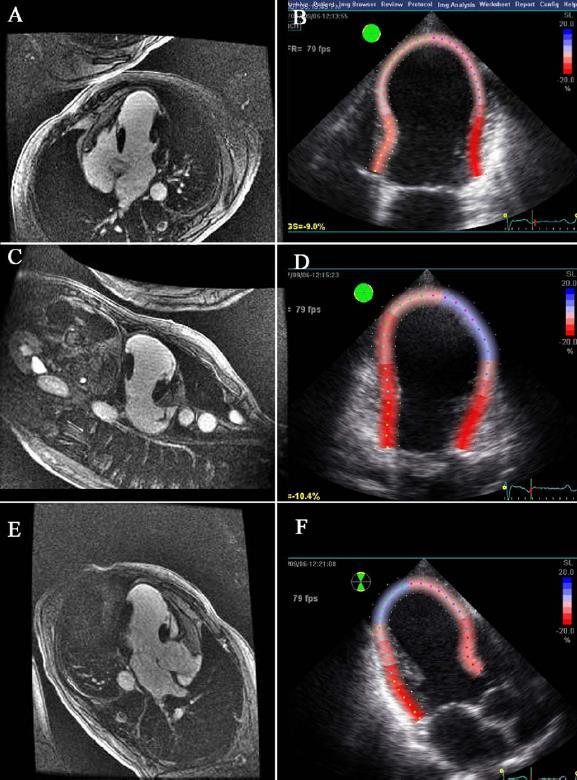 MRI+ΓΑΔΟΛΙΝΙΟ 2D-STRAIN