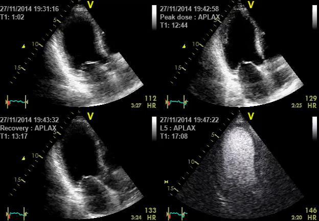 DSE: 3-Chamber PATIENT WITH ALCHOHOL