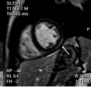 abnormalities, longitudinal deformation is diffusely impaired, whereas circumferential is