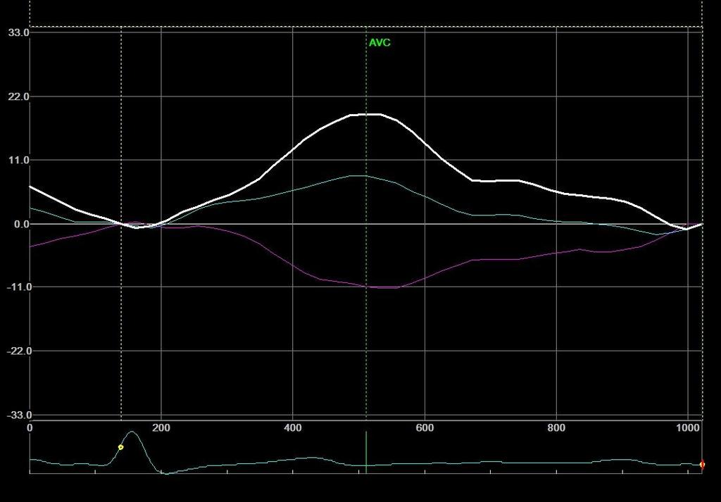 UntwMVO Δ2:79% A A Hypertensive ptw Δ1:26