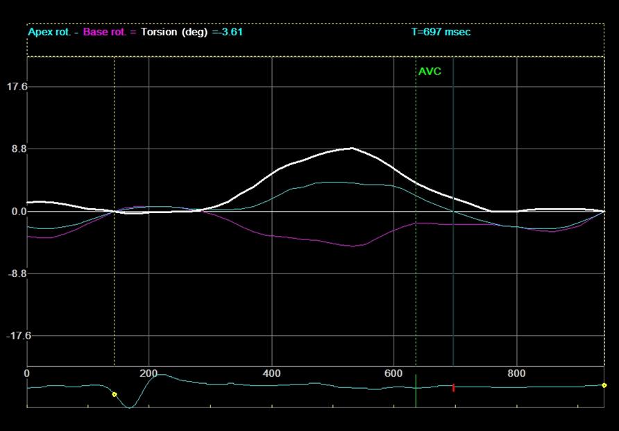 MVO EEF 26 % 64 % RA with
