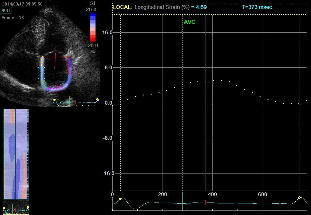Atrial