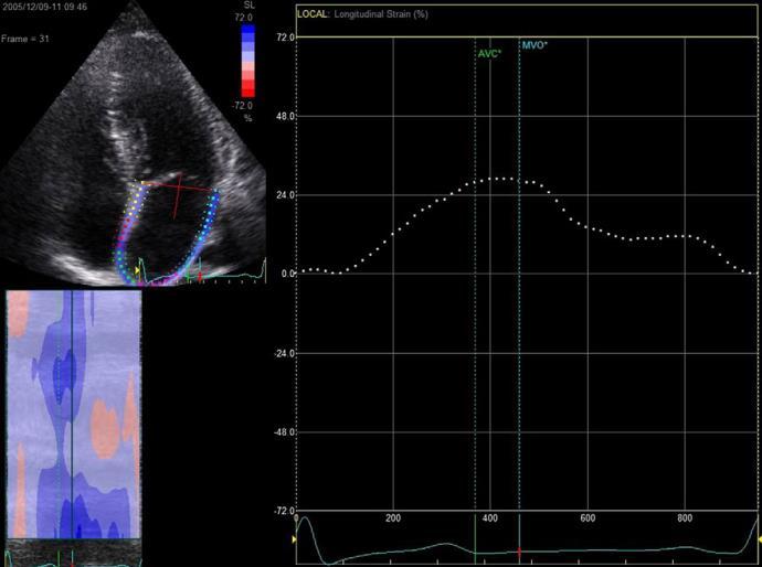 LA Deformation Predicts Eventful Course