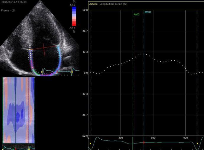 >21% Total Left Atrial Strain <21%