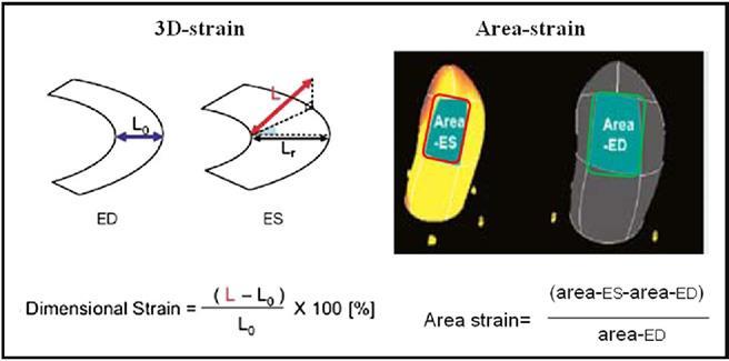 3D speckle tracking allows the quantification of 2 new 3-dimensional indexes: