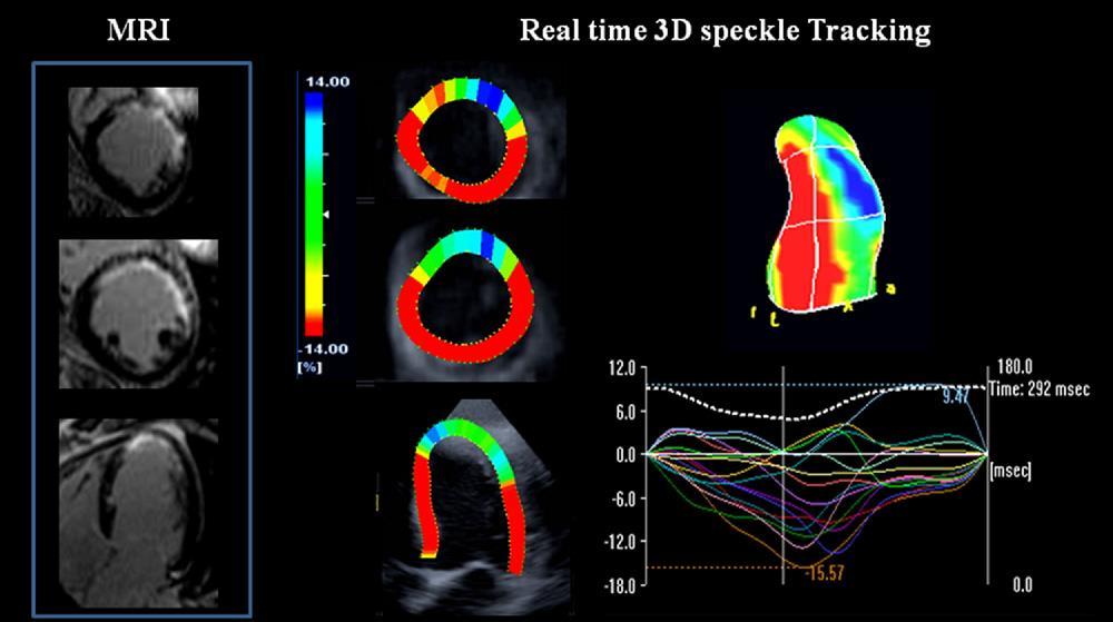 longitudinal vectors -area strain that assesses endocardial area changes.
