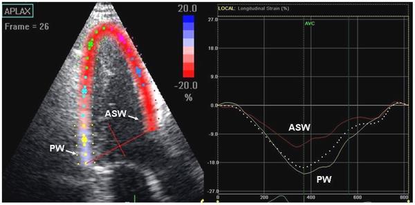 Example of impaired segmental strain measured by speckle tracking in the apical long-axis view in a mutation carrier without HCM phenotype expression. Yiu KH, Atsma DE, Delgado V, Ng ACT, et al.