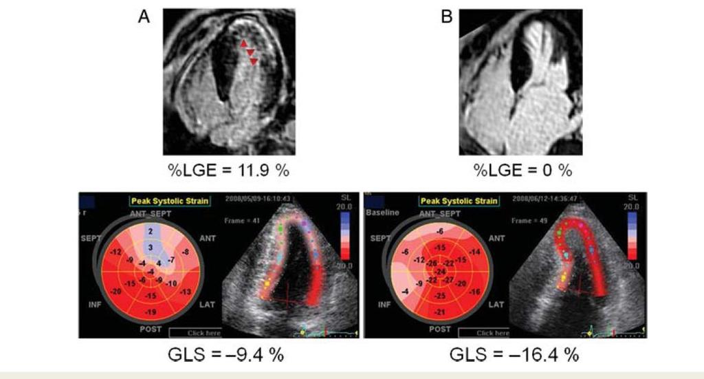 Association of GLS with fibrosis in HCM European