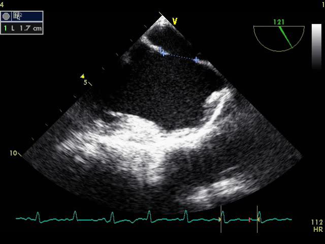 "ATRIAL SEPTAL