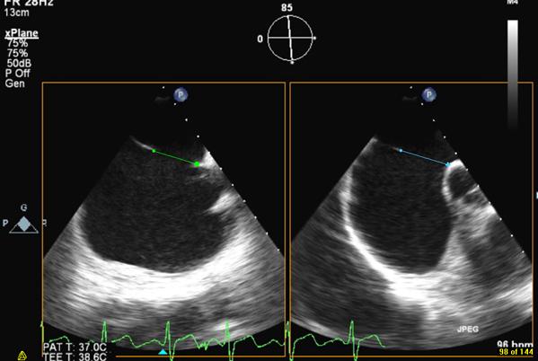 "ATRIAL SEPTAL DEFECT TRANSCATHETER CLOSU RE: