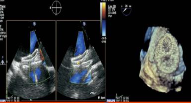 " 2D-3D TEE GUIDANCE OF