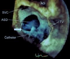 defects ASO,Cribiform A,