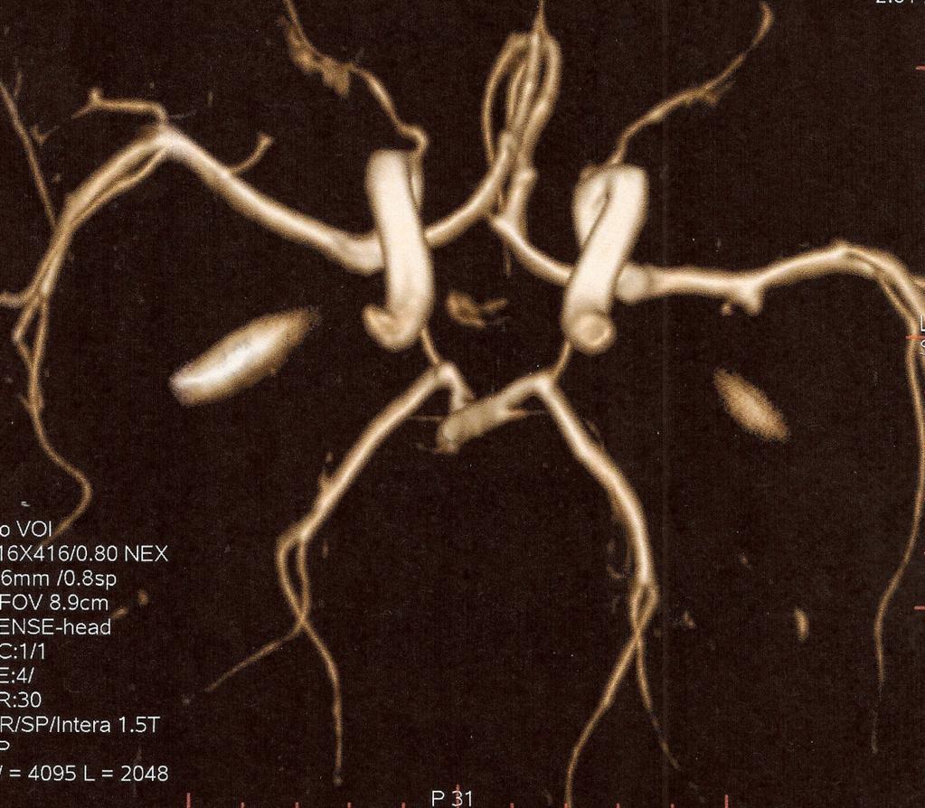 STENT IMPLANTATION FOR AORTIC