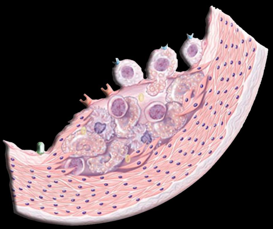 Inflammation in Cardiovascular Disease