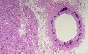 Intimal Calcification Secondary to Atherosclerosis