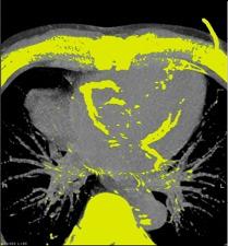 EBCT=electron beam computed tomography.