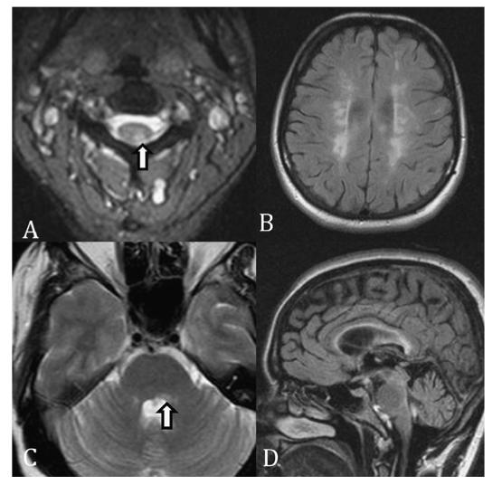 Typical CNS lesions for