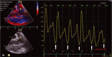 Vizzardi et al: Elastic aortic properties assessment Ιστικό strain στην ανιούσα Αο: µέγιστο συστολικό