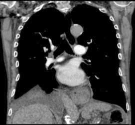 CT in suspected PE: a