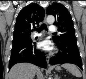 2-slice CT 1992 2 x 2.