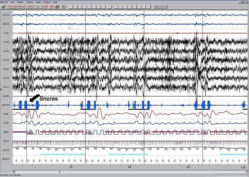 Πολυυπνογραφικές εικόνες στο ΣΑΥ Εικονα 5.2 Πολυπνογράφημα σε ασθενή που πάσχει από το ΣΑΥ. Το παραπάνω γράφημα αντιστοιχεί σε 2 λεπτά καταγραφής.