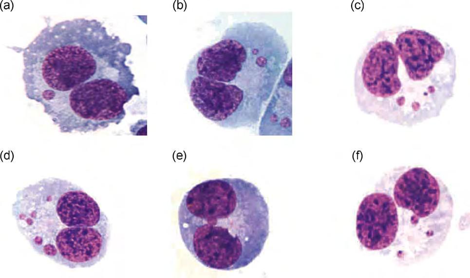 Εικόνα 9.5.2.: Φωτογραφίες διπύρηνων κυττάρων με μικροπυρήνες, όπως αυτά φαίνονται στο μικροσκόπιο. (Fenech et al., 2003). 9.5.3. Κριτήρια αναγνώρισης αποπτωτικών κυττάρων 1.