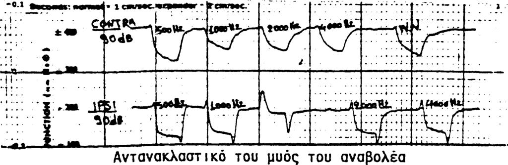 Τύπος II: Μέτριου βαθμού με πτώση όλων των συχνοτήτων και συχνά με μια απότομη κατακρήμνιση της καμπύλης μετά τα 3000 Ηζ. Τύπος III: Πλήρης κώφωση προσβάλουσα όλες τις συχνότητες.