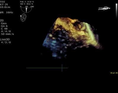 Thrombus can present in anybody with AF